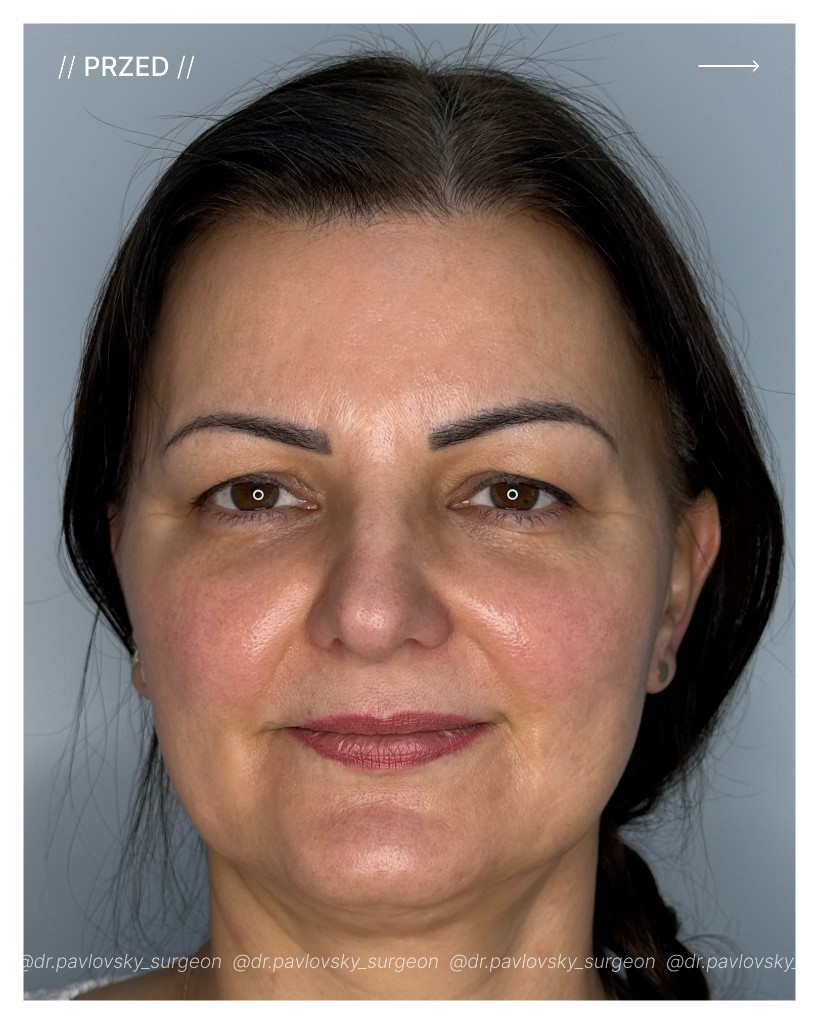 Pacjentka przed blefaroplastyką — przypadek