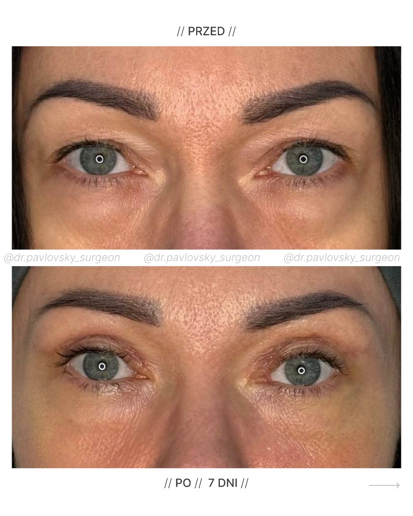 Blefaroplastyka &mdash; efekt przed i po (7 dni)