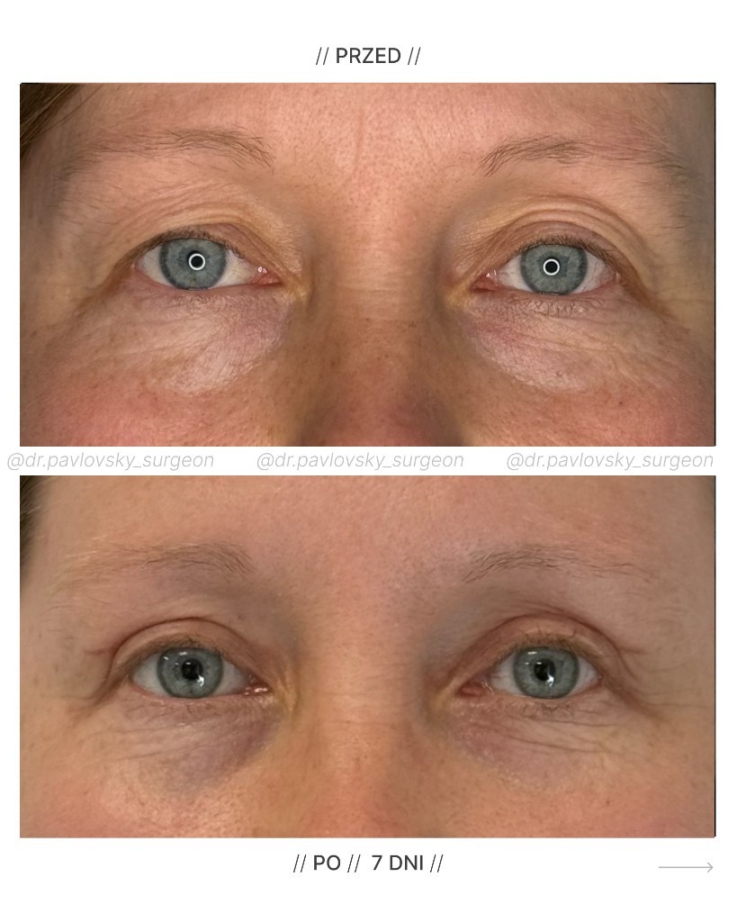 Blefaroplastyka &mdash; przed i po 7 dniach