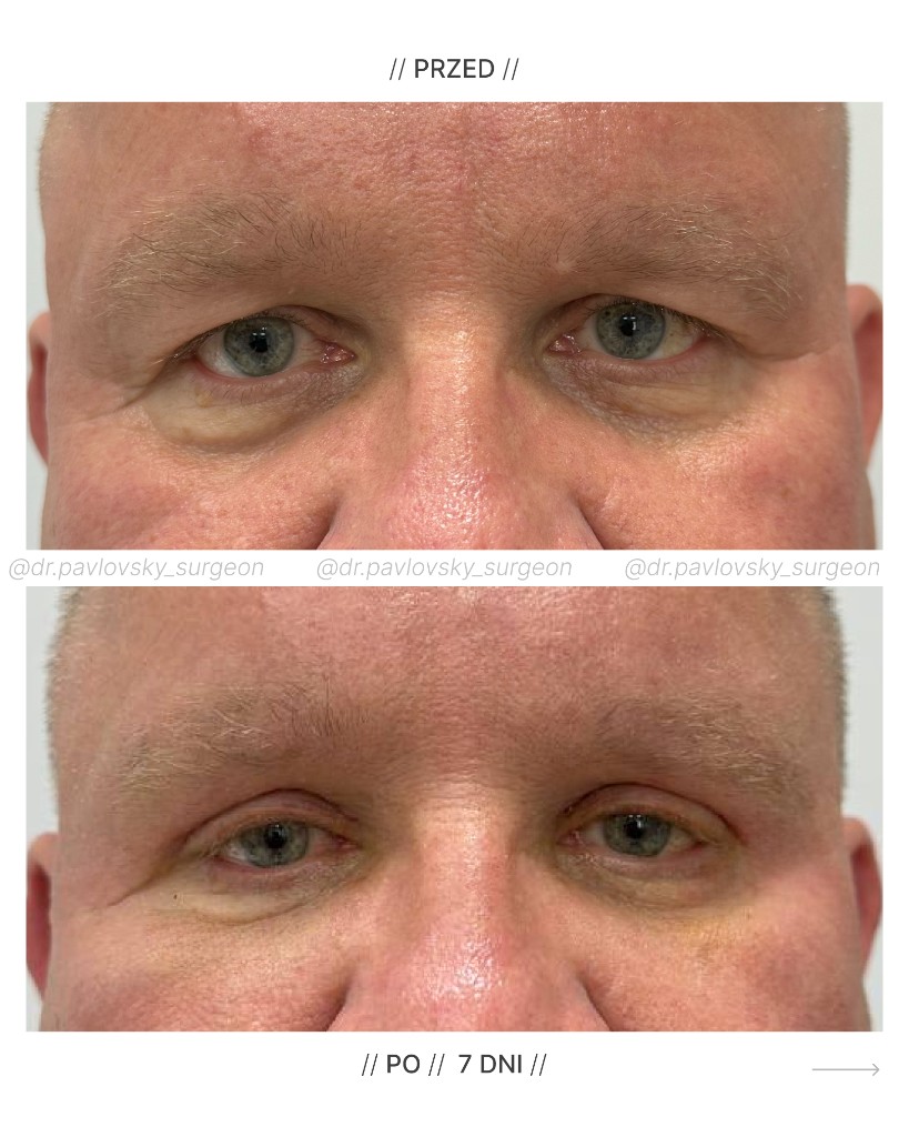 Blefaroplastyka &mdash; rezultat przed i po (7 dni)