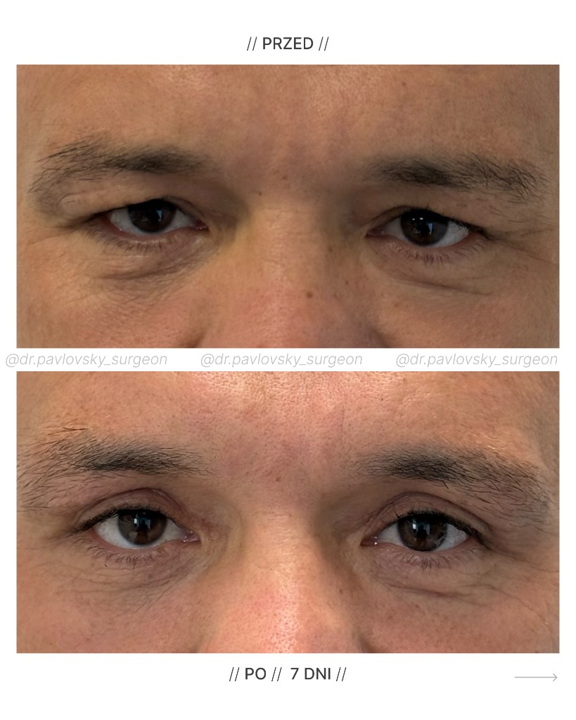 Blefaroplastyka powiek g&oacute;rnych &mdash; przed i po 7 dniach